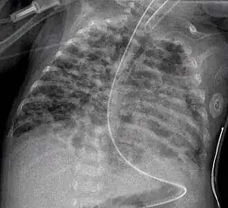 Una radiografía torácica mostrando displasia broncopulmonar.