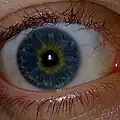 Ojo con heterocromía central azul y amarillo.
