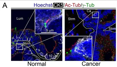 Cilia primaria en célula basal epitelial dentro de la Próstata. Arriba (ampliación): Axonema (en rojo), Centrosoma (en verde). Lum=lumen Strm=estroma.
