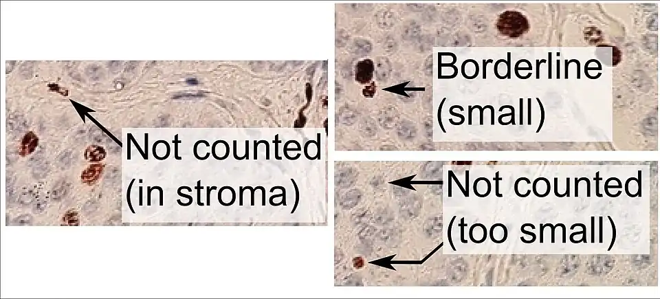 Recuento de núcleos positivos frente a negativos con marcaje Ki-67, en este caso en un tumor neuroendocrino de intestino delgado. Para contar como positivo, un núcleo debe tener una tinción oscura homogénea (no solo punteada), al menos la mitad dentro del campo de visión, ser lo suficientemente grande y no estar ubicado en el estroma.