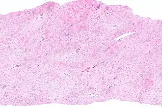Desmoid tumour -- low mag