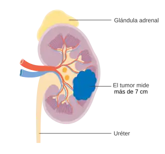 Cáncer de riñón en etapa 2