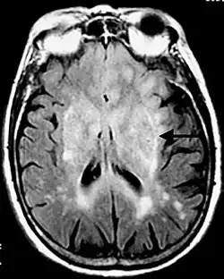 Imagen de RM en secuencia FLAIR que demuestra infiltración relacionada con tumor que involucra núcleos lenticulares (Flecha).