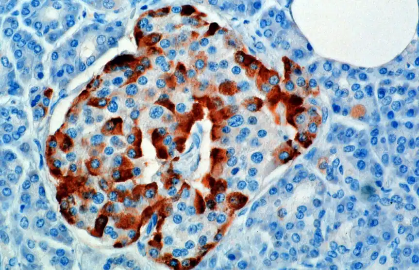 Células Alfa en rojo, en el borde (izquierda) de un islote. Inmunohistoquímica. Microscopio óptico.