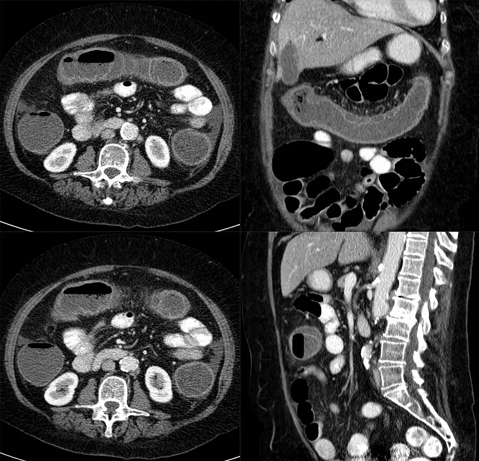 Colon (gris oscuro arriba, derecha, izquierda) en una vista superior de todo el abdomen (en corte horizontal). arriba: colon transverso (en corte longitudinal). derecha: colon ascendente (en corte transversal). izquierda: colon descendente (en corte transversal). Tomografía axial computada.