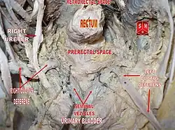 Cavidad pélvica masculina