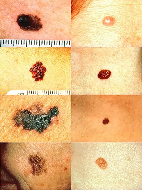 Regla ABCD para la detección de melanomas. En la columna de la izquierda y de arriba abajo: melanomas mostrando: *(A) asimetría, *(B) un borde que es irregular o con muescas, *(C) coloración con diferentes tonos de color marrón o negro, y *(D) un diámetro que cambia de tamaño. En la columna derecha hay lunares normales que no tienen características sospechosas de malignidad (no hay asimetría, el borde es regular, el color es de tono bronceado, y sin cambios en el diámetro).