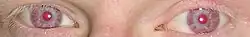 Ojos rojos de una persona albina.