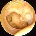Otitis media crónica mesotimpánica