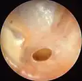 Otitis media crónica mesotimpánica