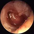 Otitis media crónica mesotimpánica