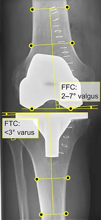 - CFF: ángulo del componente femoral frontal. Por lo general, se considera óptimo cuando se encuentra entre 2 y 7° en valgo.[55]​ - CTF: ángulo del componente tibial frontal, que se considera óptimo cuando se encuentra en ángulo recto. En general, se ha encontrado que una posición en varo de más de 3 ° aumenta la tasa de falla de la prótesis.[55]​
