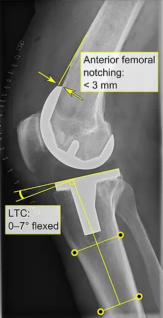 - La entalladura femoral anterior (el componente femoral que causa una reducción del grosor del fémur distal en la parte anterior) parece aumentar el riesgo de fracturas cuando excede aproximadamente 3 mm.[56]​ - CTL: ángulo del componente tibial lateral (o sagital), que está idealmente posicionado de modo que la tibia esté flexionada de 0 a 7° en comparación con un ángulo recto con la placa tibial.[55]​