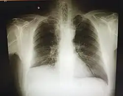 Rx de neumonectomía o lobectomía en pulmón derecho