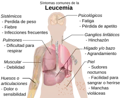 Síntomas de la leucemia.