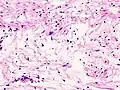 Schwannoma subcutaneo Antoni B