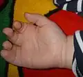 Sindactilia de la mano