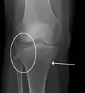 Una fractura de meseta tibial vista con rayos-X