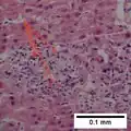 Micrografía de un infarto en el conducto biliar, con núcleos picnóticos (flechas) (400x).